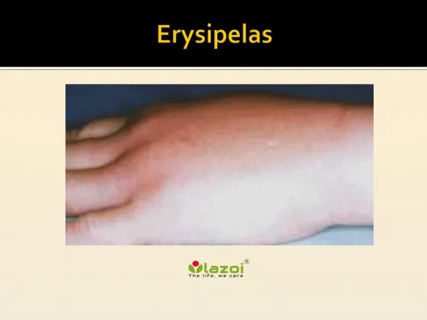 Erysipelas: Symptoms, Causes, Diagnosis and Treatment