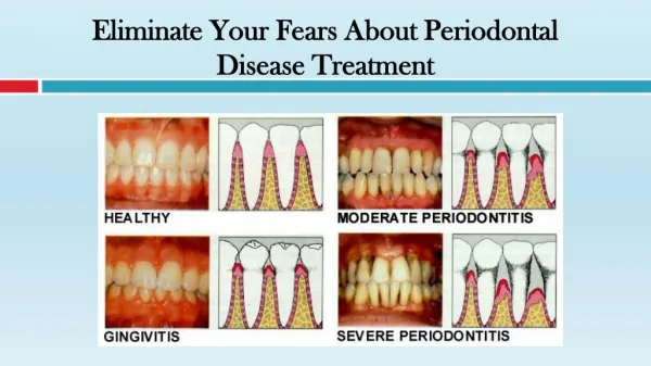 Eliminate Your Fears About Periodontal Disease Treatment