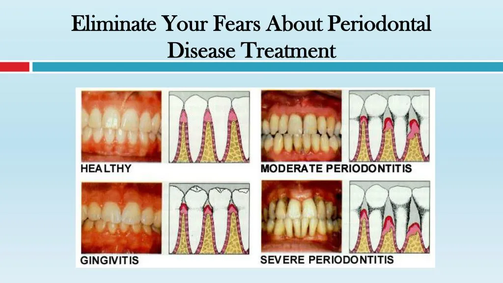 eliminate your fears about periodontal disease treatment