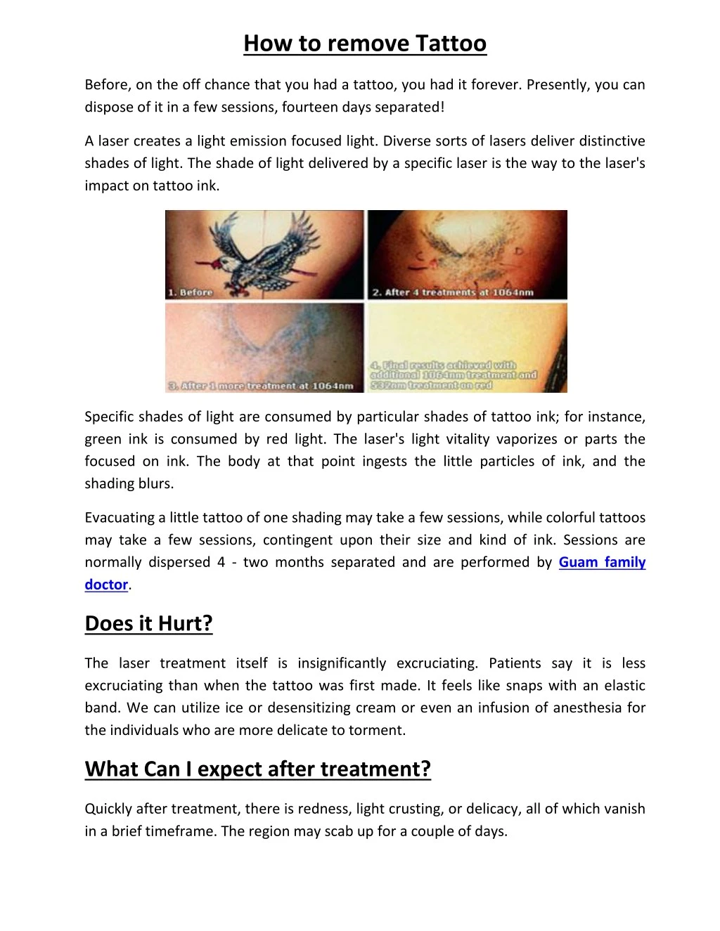 how to remove tattoo