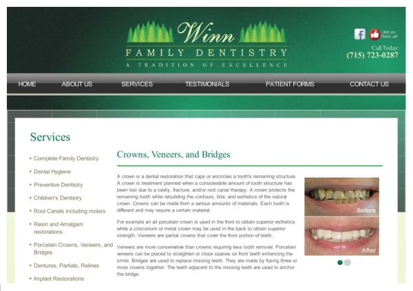 Crowns veneers bridges - Winn family Dentistry