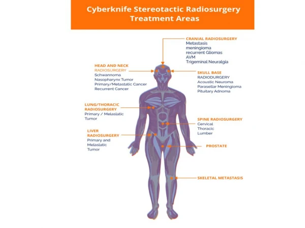 Cyberknife treatment and Surgery with Laser / Radiation therapy in India