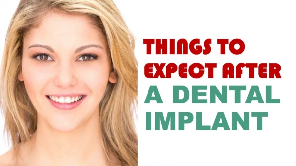Things to Expect After a Dental Implant