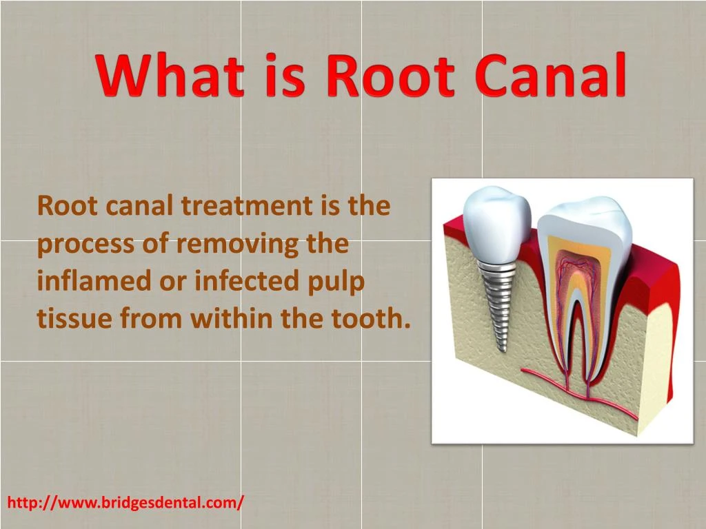what is root canal