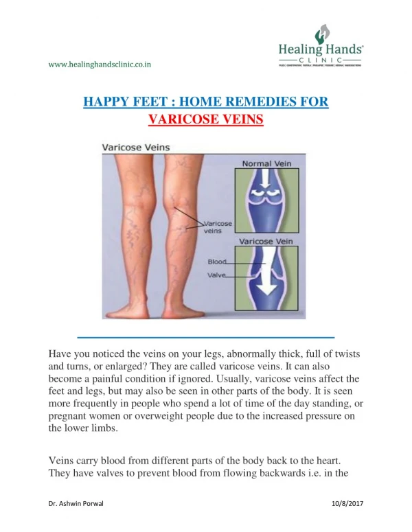 Get rid of varicose veins by Home remedies