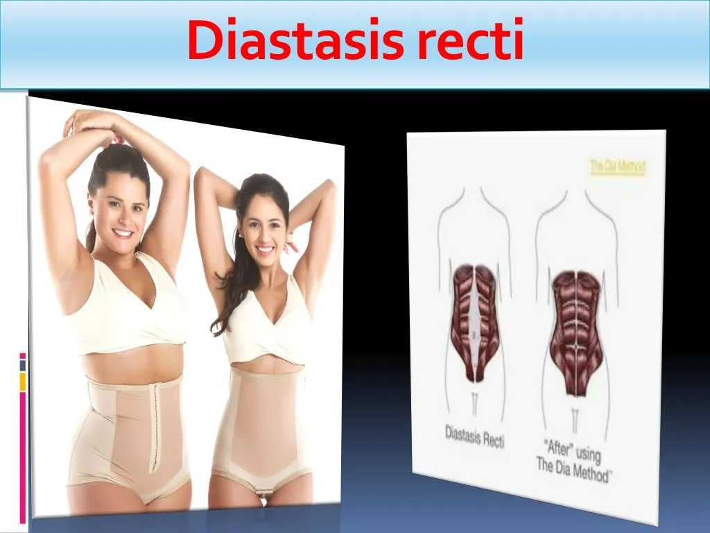diastasis recti