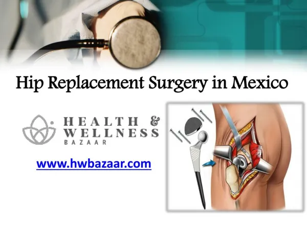 Hip Replacement Surgery in Mexico at Very Affordable Rates