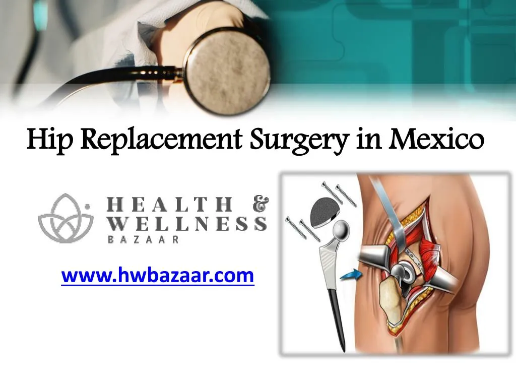 hip replacement surgery in mexico