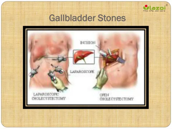 Gallbladder stones: Learn about symptoms, causes and treatment