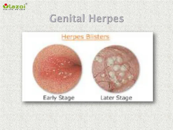 Genital herpes: Symptoms, Causes, Diagnosis and Treatment