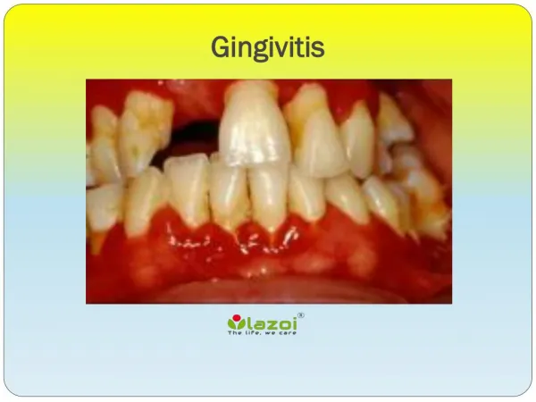 Gingivitis: Symptoms, Causes, Diagnosis and Treatment