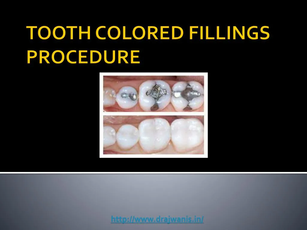 tooth colored fillings procedure