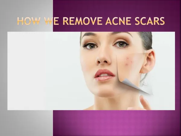 How we remove acne scars and get glowing skin