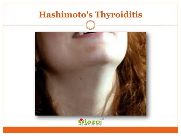 Hashimoto's thyroiditis: The most common form of thyroiditis