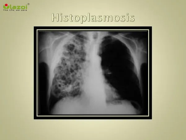 Histoplasmosis (fungal infection of the lungs): Symptoms, causes and treatment