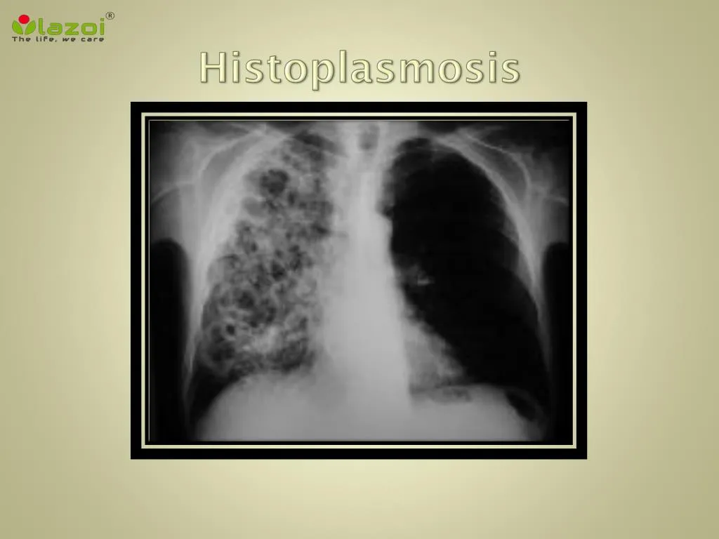 histoplasmosis