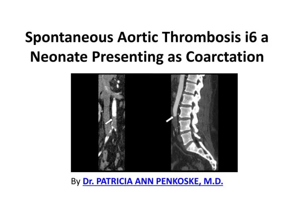 Spontaneous Aortic Thrombosis i6 a Neonate Presenting as Coarctation