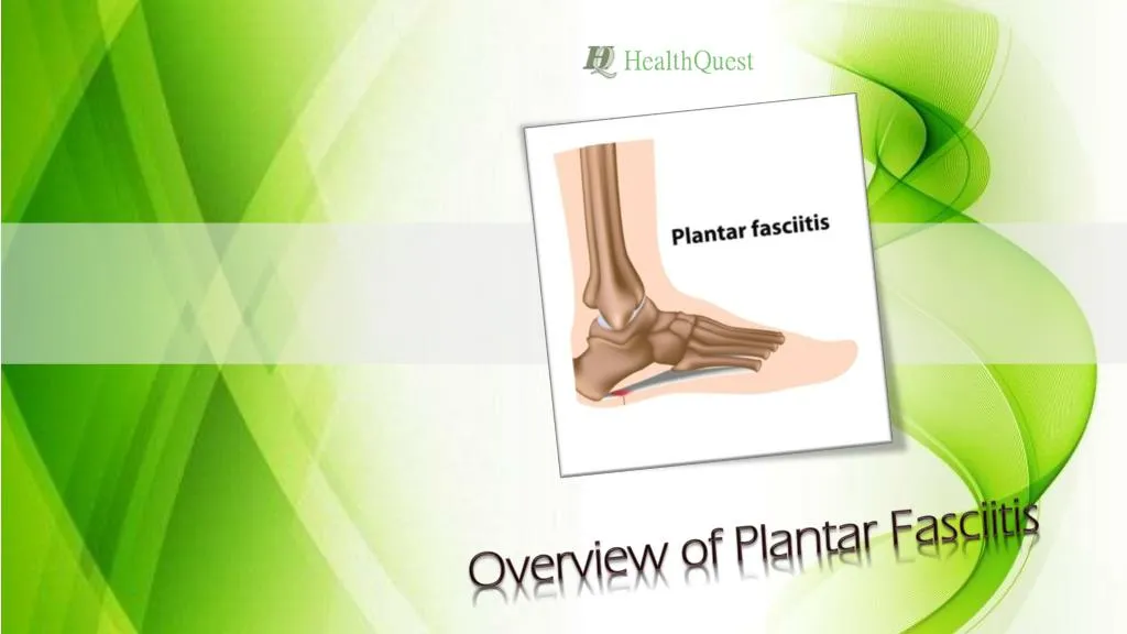 overview of plantar fasciitis