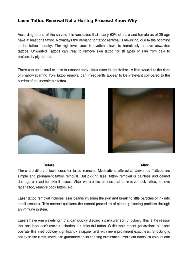 Laser Tattoo Removal Not a Hurting Process! Know Why