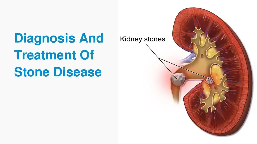 diagnosis and treatment of stone disease