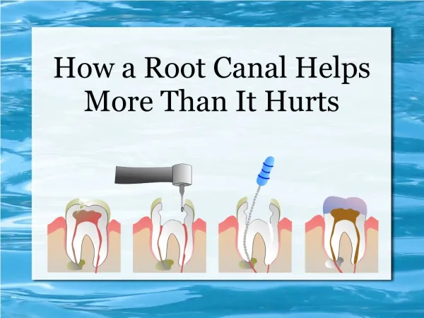 How a Root Canal Helps More Than It Hurts