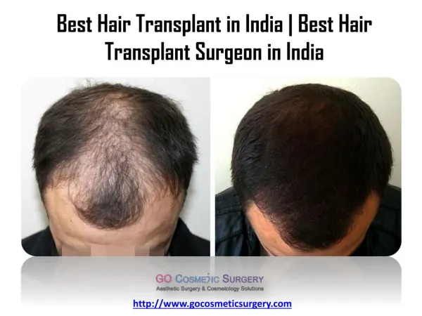 Best Hair Transplant in India | Best Hair Transplant Surgeon in India