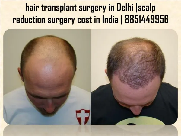 Outstanding hair transplant surgery in Delhi | scalp reduction surgery cost in India