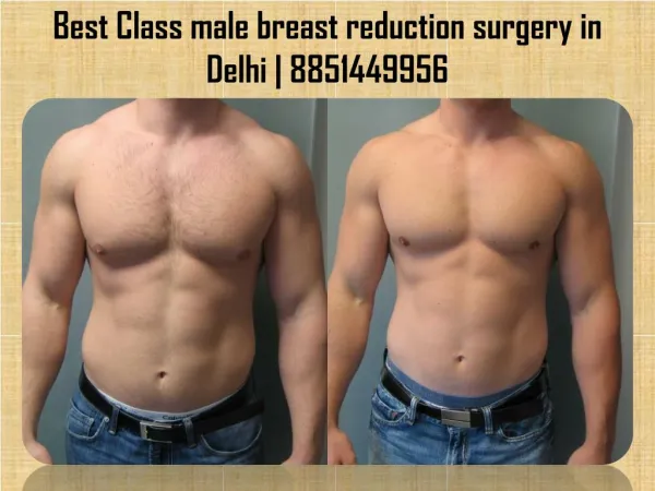 male breast reduction surgery in Delhi - male chest reduction surgery cost in India