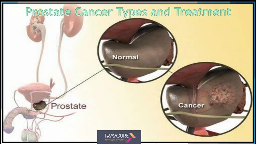 prostate cancer types and treatment