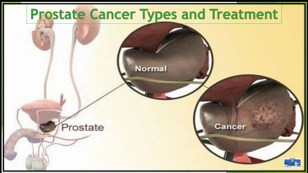prostate cancer types and treatment