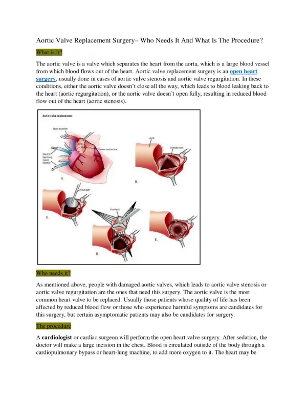 Aortic Valve Replacement Surgery– Who Needs It And What Is The Procedure?