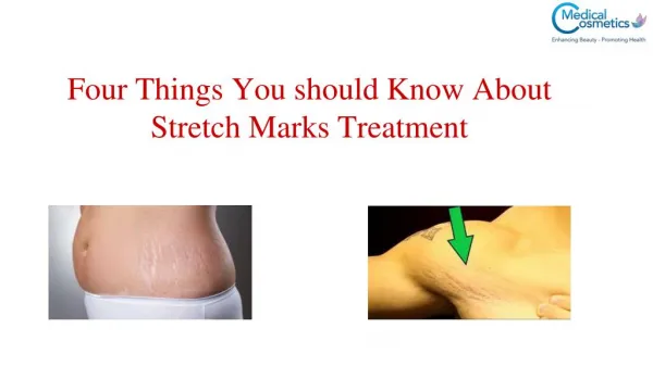 4 Things You should Know About Stretch Marks Treatment
