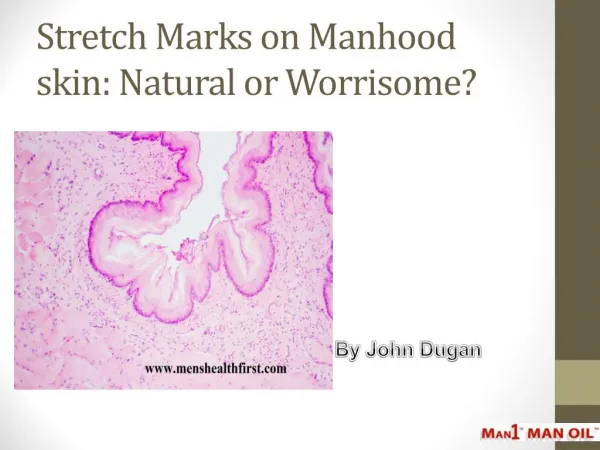 Stretch Marks on Manhood skin: Natural or Worrisome?