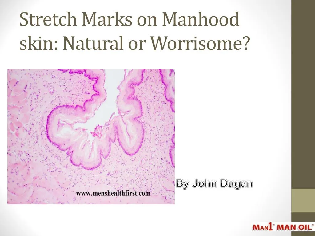 stretch marks on manhood skin natural or worrisome