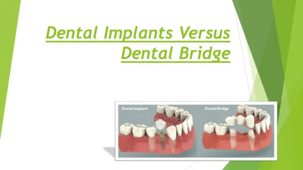 Dental Implants Versus Dental Bridge