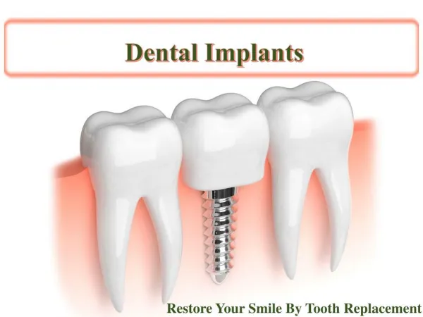 A Complete Guide to Dental Implants Treatment