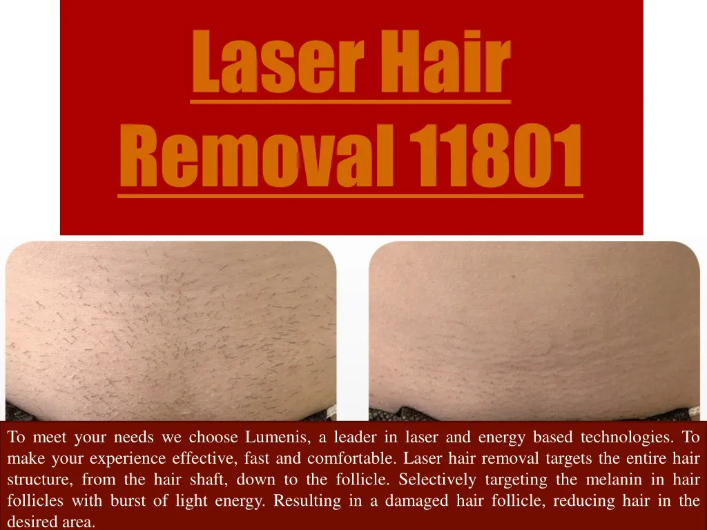laser hair removal 11801