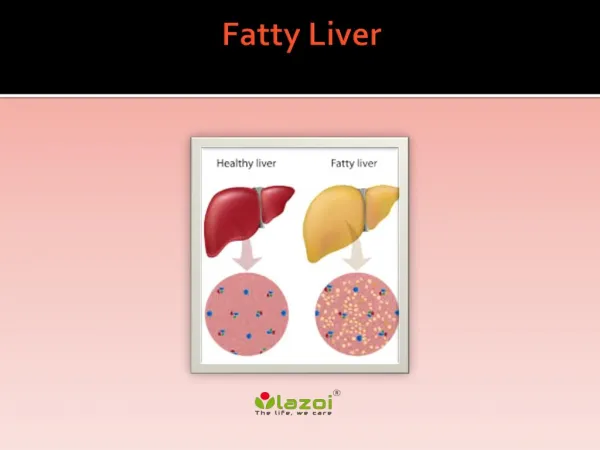 Fatty Liver : Overview, symptoms, causes, risk factor, diagnosis and treatment