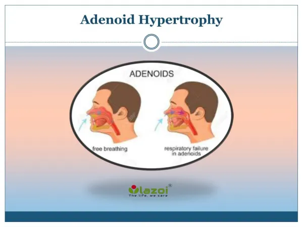 Adenoid hypertrophy Causes, Symptoms, Diagnosis, Prevention Treatment in India