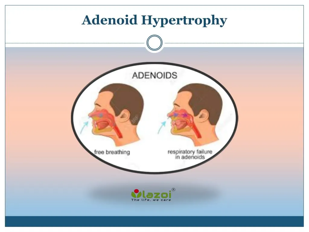 adenoid hypertrophy