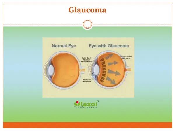 An overview of Glaucoma symptoms, causes and treatment