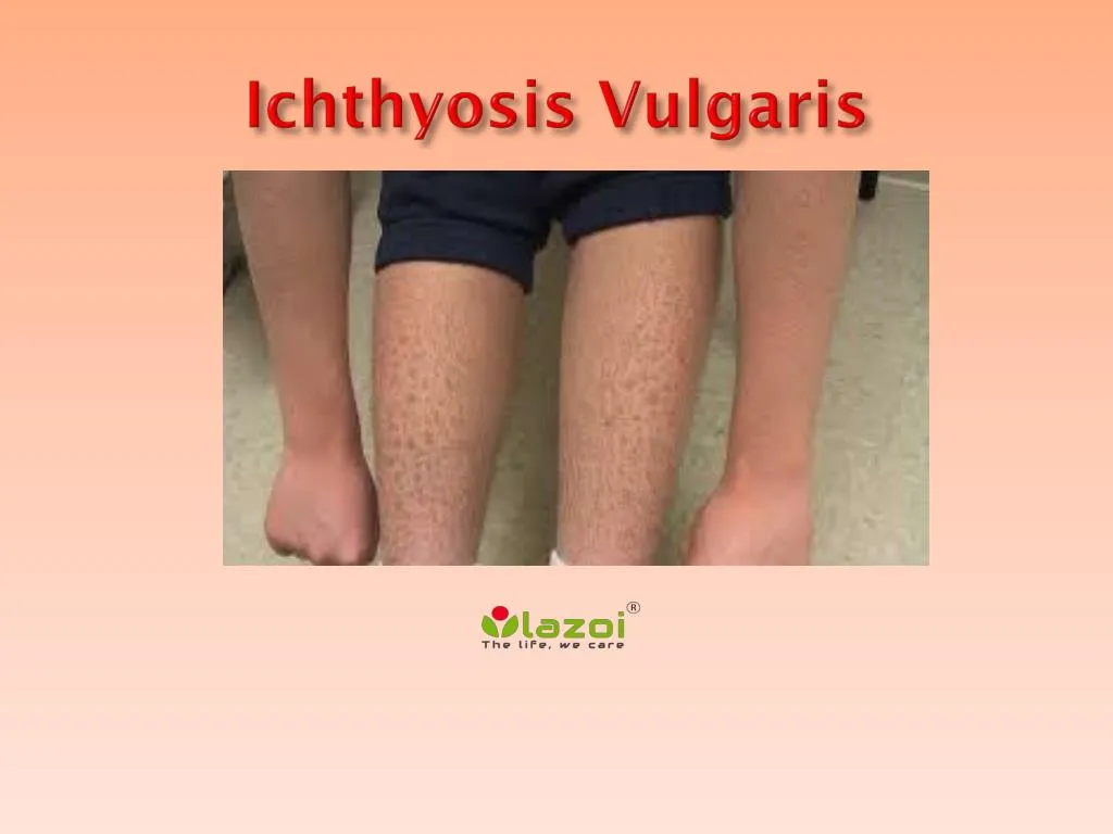 ichthyosis vulgaris