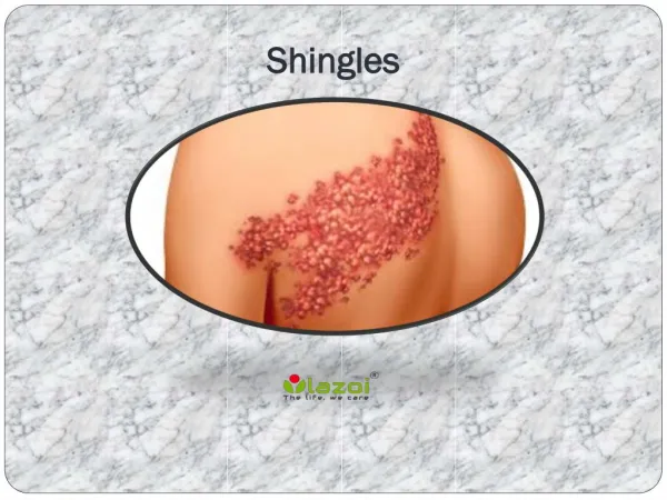 Shingles: Symptoms, Risk factors, Causes, Diagnosis and Treatment