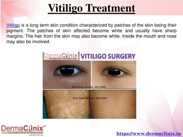 Vitiligo Treatment