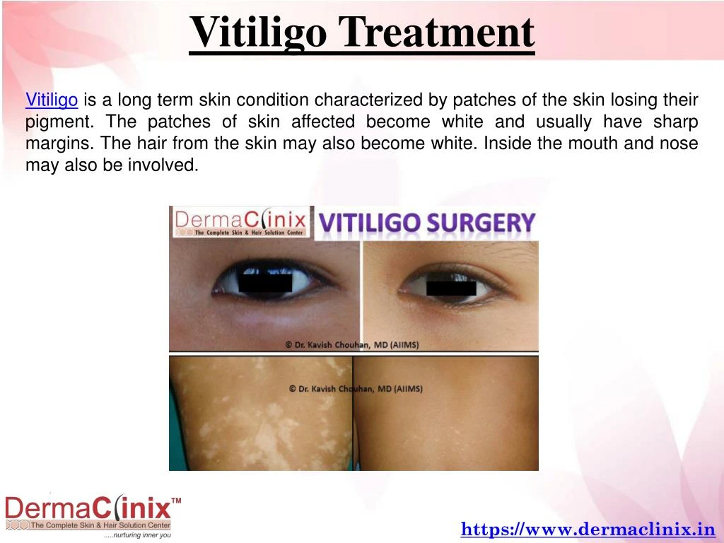 vitiligo treatment