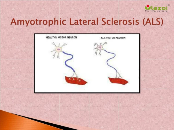 Amyotrophic Lateral Sclerosis (ALS): Symptoms, causes and treatment