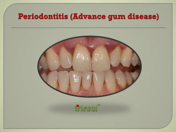 Periodontitis (Advance gum disease): Symptoms, causes and treatment