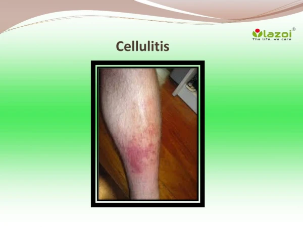Cellulitis: Symptoms, Causes, Diagnosis, Treatment, Prevention and Complications