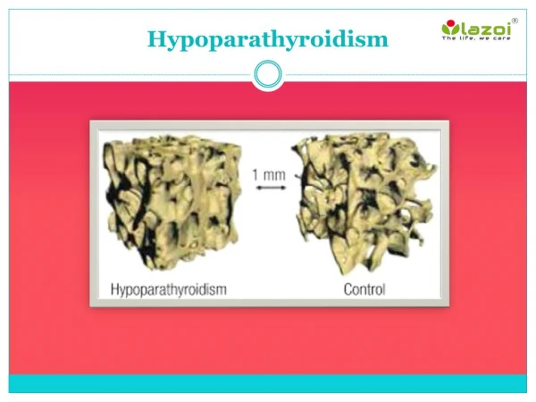 Hypoparathyroidism: Symptoms, Causes, Treatment and more