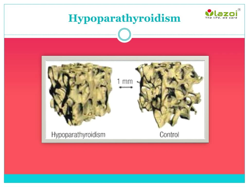 hypoparathyroidism